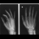 Luxation in carpometacarpal joint, after reposition: X-ray - Plain radiograph